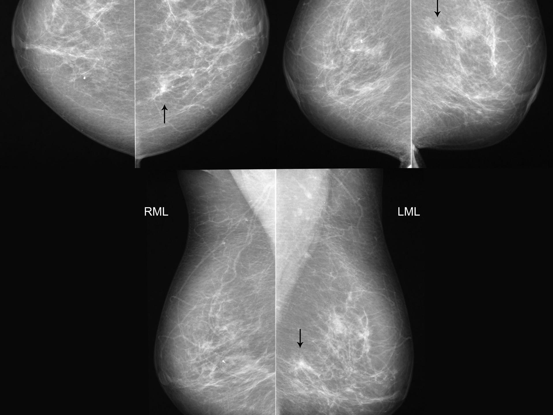 Mammographie-Screening